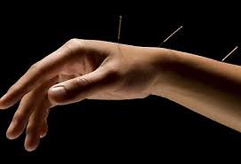 What Acupuncture can treat. hand